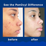 PanOxyl, Acne Creamy Wash, Benzoyl Peroxide 4% Daily Control