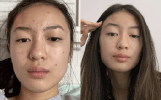 Differin 0.1% Adapalene Acne Treatment Gel