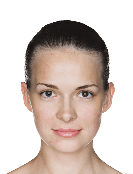 Differin 0.1% Adapalene Acne Treatment Gel